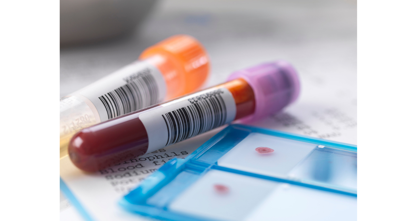 Das bild zeigt einen Testbogen für Blutwerte. Auf diesem Testbogen liegen zwei Ampullen mit abgenommenen Blut. Das Bild steht symbolisch für die Ergebnisse, die der Wirkstoff Tulisokibart bei Patient:innen mit Morbus Crohn und Colitis ulcerosa hervorgerufen hat. Diese sind positiv.