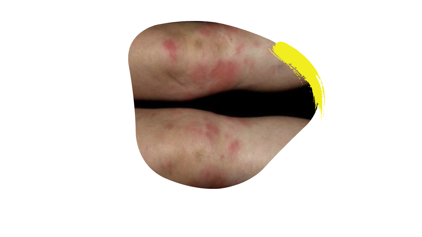 Das bild zeigt zwei Beine die mit der Hauterkrankung Erythema nodosum befallen sind. Die Hauterkrankung ist eines der weniger bekannten Krankheitsbilder, das auch bei Colitis ulcerosa und Morbus crohn aufrtritt.