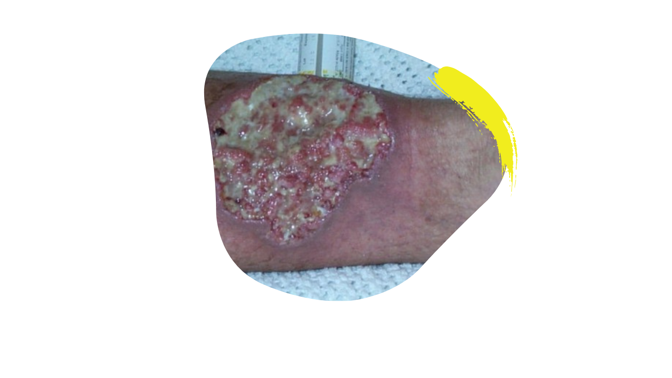 Das Bild zeigt die Hauterkrankung Pyoderma gangraenosum. Das ist ein weiteres der weniger bekannten Krankheitsbilder, das bei Colitis ulcerosa und Morbus crohn vorkommen kann.