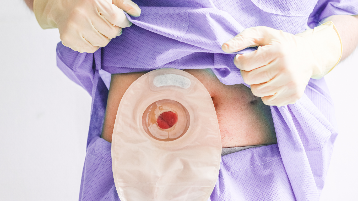 J-Pouch, Stoma, Beuteltier: Was ist das und warum ist es fr  CED-Patient:innen wichtig?  coreway