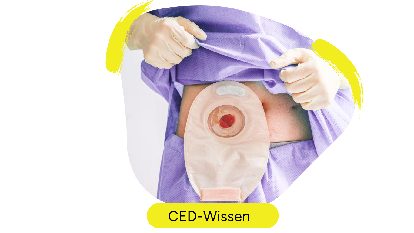 Die Person hebt das lilafarbene Oberteil an. Darunter verbirgt sich ein ileoanales Pouch vermutlich temporär eingesetzt für eine weitere jpouch operation später. Die Pouch wird auch als Stomabeutel berzeichnet. Das Bild steht symbolisch für Stomabeutel und stoma-Operationen